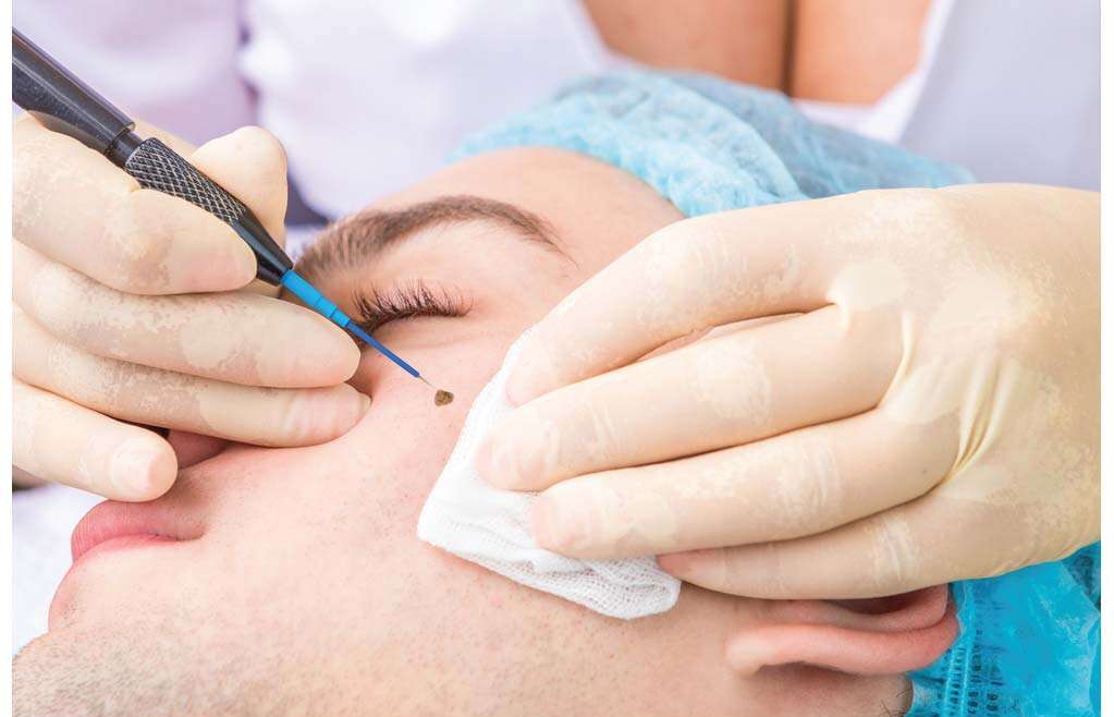 Electrocautery and Radiofrequency Ablation