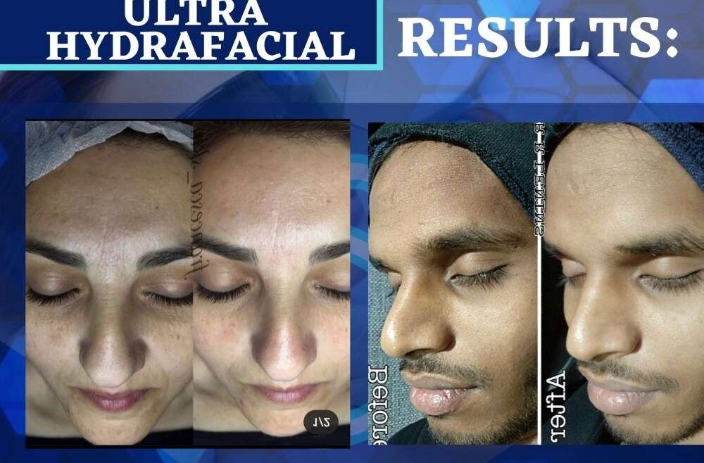 Hydra Facial
