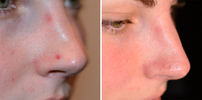 Mole Removal